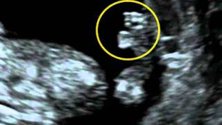 Fetal Medicine Foundation  Short Rib Polydactyly Syndrome [upl. by Iad361]