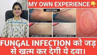 Fungal infection।Joke itch।Homeopathic medicine for cure। [upl. by Velleman]