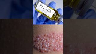 How Chicken Pox Leads to Shingles Herpes Zoster chickenpox shingles vaccine shorts DMC [upl. by Ofilia760]