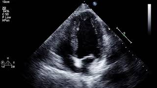 The EchoWeb  Patient Diagnosed with LV Diastolic Dysfunction and Reduced EF [upl. by Ydal]