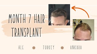 Loving It Month 7 Hair Transplant HLC clinic Turkey [upl. by Gaspard808]