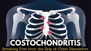 Costochondritis Breaking Free from the Grip of Chest Discomfort [upl. by Hanforrd371]