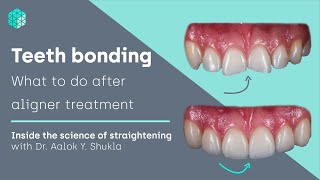 Teeth bonding  what to do after aligner treatment  Inside the science of teeth straightening [upl. by Notle186]