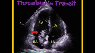 Thrombus in transit inside the Right Atrium Echocardiography  3D [upl. by Jacquenetta978]