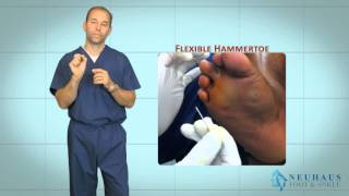 New Hammertoe Correction Procedure Performed in the Office [upl. by Stoecker]