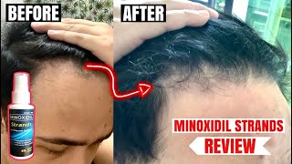 Minoxidil Strands Review RESULT after using for 5 months  Effective or Not [upl. by Lodovico167]