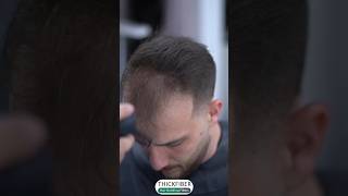 How to cover the Thin amp Fine Hair hairloss [upl. by Adianez]