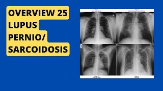 Overview 25  Lupus pernio  Sarcoidosis [upl. by Enyaz444]