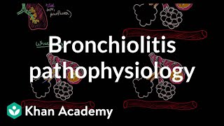 Bronchiolitis pathophysiology  Respiratory system diseases  NCLEXRN  Khan Academy [upl. by Vittorio]