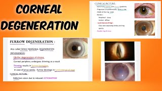 corneal degeneration classification  symptoms  treatment  ophthalmology  English [upl. by Dietsche683]