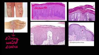 DermaPath SeriesPsoriasis [upl. by Nuahsyd]