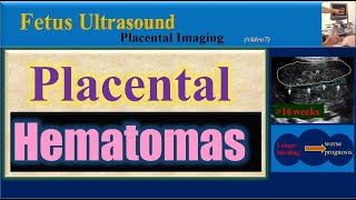 Fetus Ultrasound Placental Hematomas [upl. by Joliet]