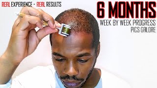 Derma roller Hair Regrowth Results 6 Months  Month by Month Progress  Coffee as a DHT Blocker [upl. by Adanama250]