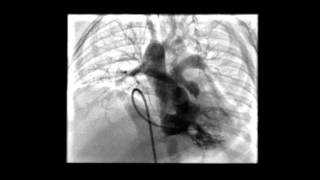 Tetralogy of Fallot RV Angiogram [upl. by Ahgem]