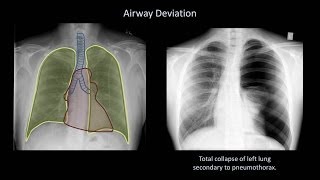 How to Interpret a Chest XRay Lesson 4  Airways Bones and Soft Tissues [upl. by Rolecnahc279]