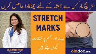 STRETCH MARK REMOVAL  Best Medical To Home Remedies  Why You SHouldnt Be Ashamed  Lex Fitness [upl. by Tibbs]