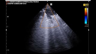 POCUS in Clinic 9 what is the difference between Xray CTchest and Lung US [upl. by Eiuqram435]