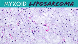 Myxoid Liposarcoma explained in 5 minutes basic soft tissue pathology sarcoma pathologists [upl. by Lim713]