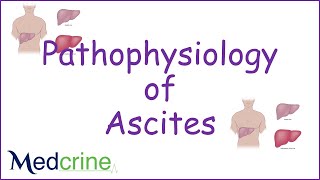 pathophysiology of ascites [upl. by Casilda]