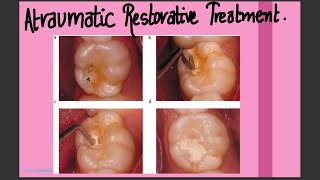 Atraumatic restorative treatment ART dental publichealthdentistry pediatricdentistry [upl. by Irafat]