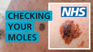 How do I check if my mole is skin cancer  NHS [upl. by Nyladnewg158]