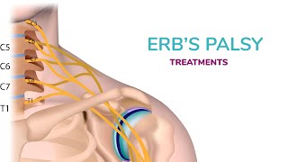 Erbs Palsy Treatment in Newborn [upl. by Stav]