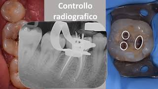 Devitalizzazione di un dente molare [upl. by Tahp]