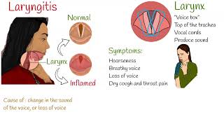 Laryngitis  Symptoms causes and treatment [upl. by Kemppe856]