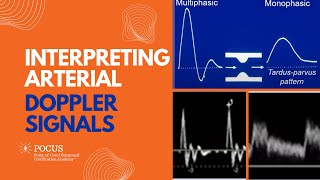 Interpreting Arterial Doppler Signals [upl. by Summer]