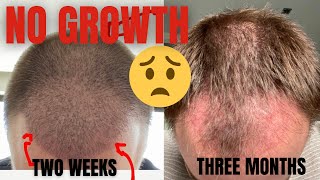 Hair Transplant 3 Months NO GROWTH [upl. by Satterfield]