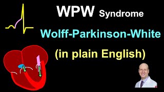 WPW Explanation and Treatment  in Plain English [upl. by Treve]