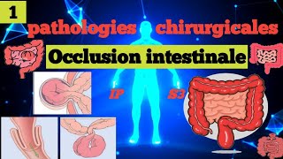 cours S3  Pathologies Chirurgicales et SI  Occlusion Intestinale Aiguë 1 OIA🩺🎯📚شرح سهل و مبسط 📚 [upl. by Melony]