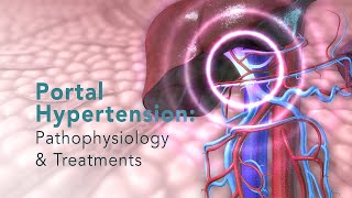 PORTAL HYPERTENSION Pathophysiology and Common Treatments [upl. by Emylee]