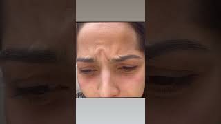 Avoiding Brow Droop in Omega Pattern Frown  Expert Botox Tips [upl. by Ramad803]