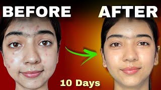 I Tried An Acne Treatment For 10 Days and this Happened 😱 [upl. by Alah]