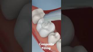 Composite Filling  Unique Dental Care Home [upl. by Anerat]