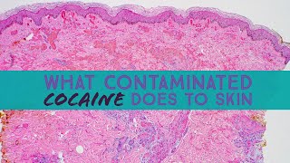 What contaminated cocaine does to skin Levamisole Vasculopathy dermpath dermatology pathology [upl. by Genevra]