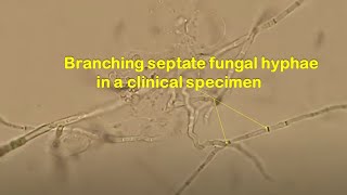 Branched Septate Fungal hyphae in Clinical Specimen [upl. by Onaicram]