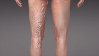 What are Varicose Veins [upl. by Athey]