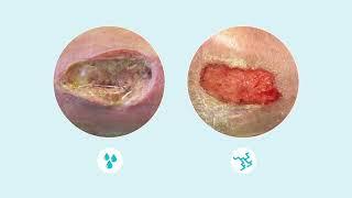 How to assess wound exudate [upl. by Annawd]