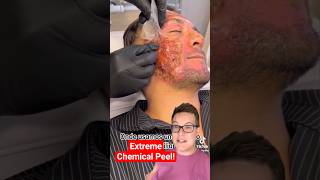 SHOCKING CHEMICAL PEEL  Phenol Peel Results shorts [upl. by Oalsinatse]