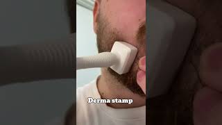 This Is How I Grew A Beard Using Minoxidil And A Derma Stamp [upl. by Dustie]