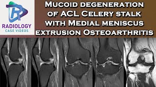 Mucoid degeneration of ACL Celery stalk with Medial meniscus extrusion Osteoarthritis [upl. by Suiramad]