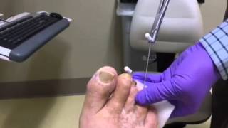 Hammertoe Pin Removal [upl. by Fernanda]