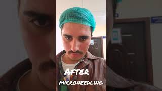 microneedling before after for your experience skin acne scar [upl. by Yrokcaz]