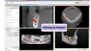 SIMPLANT Introduction to 3D Surgical Guide Modeling [upl. by Varini]