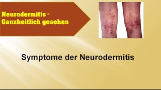 Symptome der Neurodermitis  Ganzmedizin Naturheilpraxis [upl. by Nwahsud]