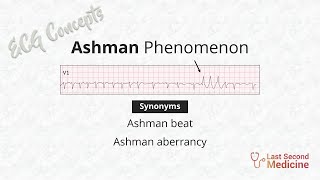 Ashman phenomenon  Ashman Beat  Ashman Aberrancy [upl. by Lerred]