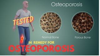 14 POSSIBLE REMEDIES FOR OSTEOPOROSIS [upl. by Nabatse758]