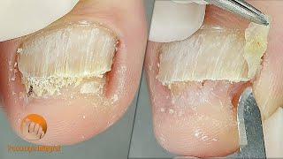 2 cases 1 video XI  1 Onychomycosis  2 Onychogryphosis Podological treatment [upl. by Mcmahon]